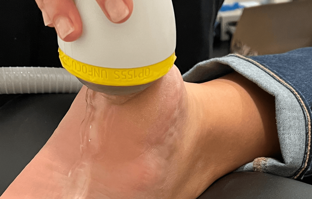 SoftWave Therapy for Chronic Diabetic Foot Ulcers: A Non-Invasive Path to Wound Healing SoftWave Therapy for Chronic Diabetic Foot Ulcers: A Non-Invasive Path to Wound Healing